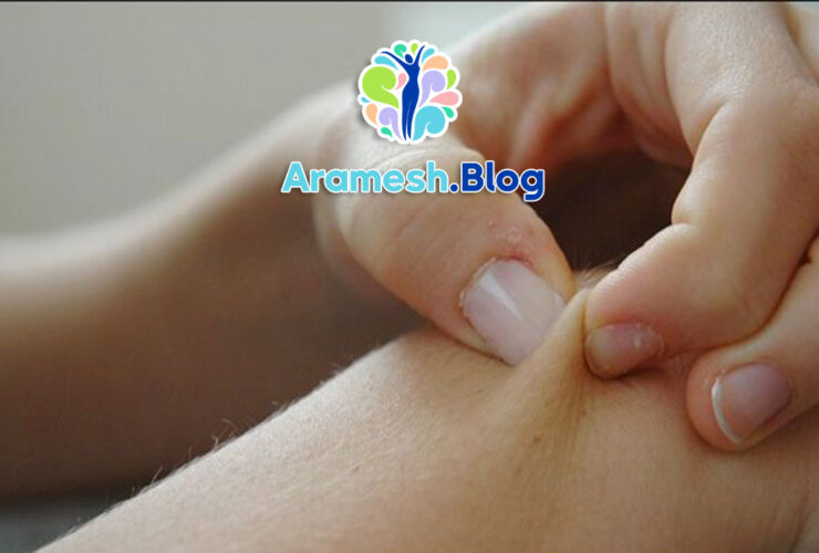 اختلال پوست کنی: شناخت، علل، علائم و درمان