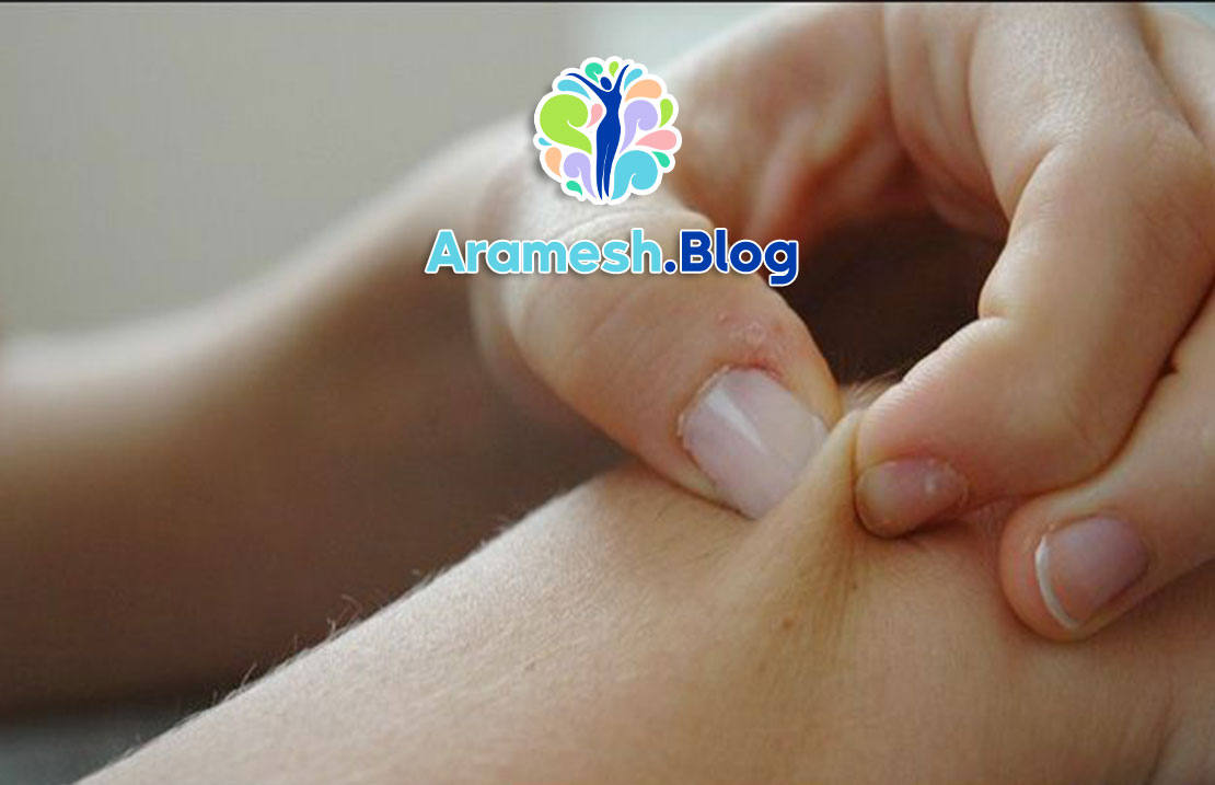 اختلال پوست کنی: شناخت، علل، علائم و درمان 1 اختلال پوست کنی: شناخت، علل، علائم و درمان