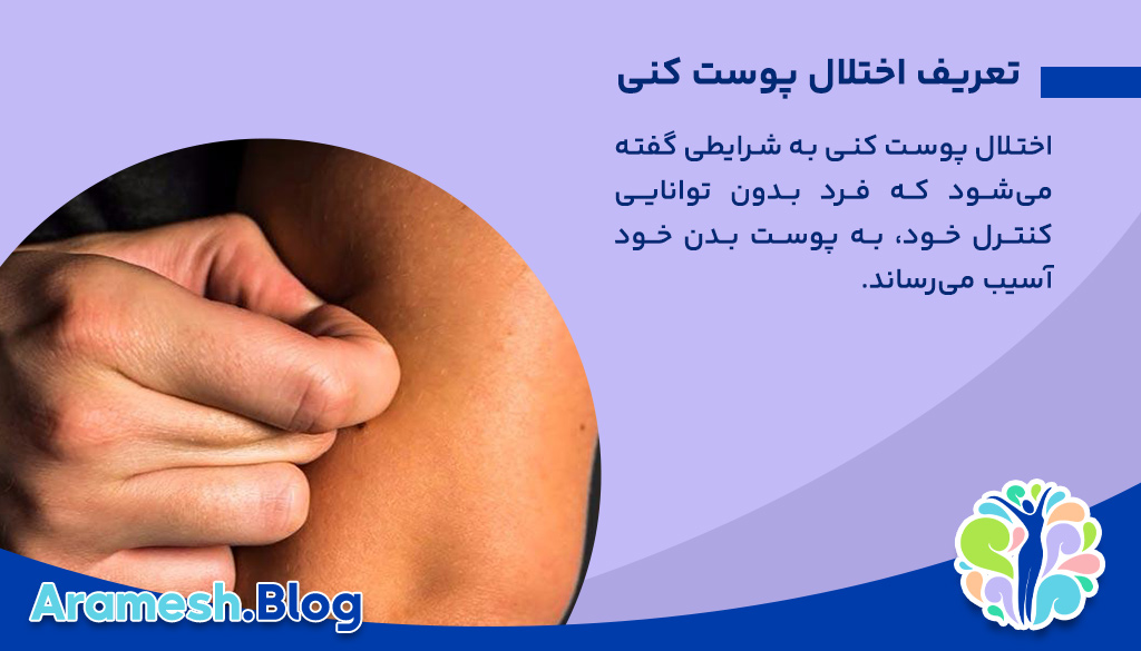 اختلال پوست کنی: شناخت، علل، علائم و درمان 2 اختلال پوست کنی: شناخت، علل، علائم و درمان