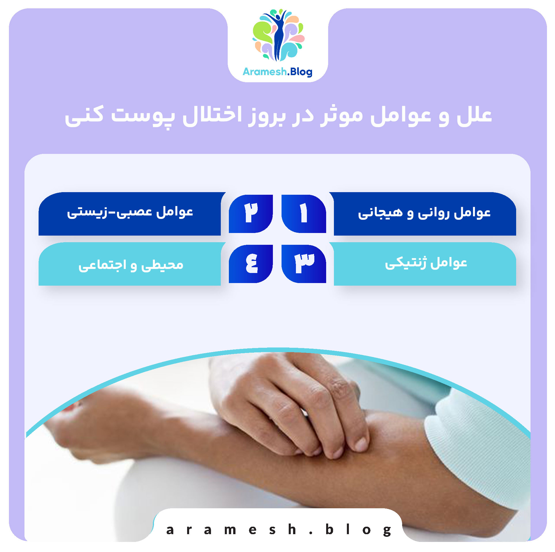 اختلال پوست کنی: شناخت، علل، علائم و درمان 3 اختلال پوست کنی: شناخت، علل، علائم و درمان