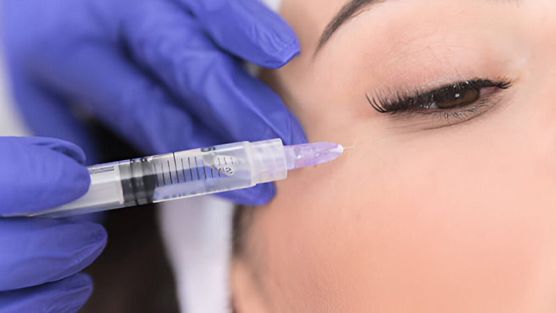 کبودی بعد از تزریق فیلر زیر چشم | دلایل، پیشگیری و درمان
