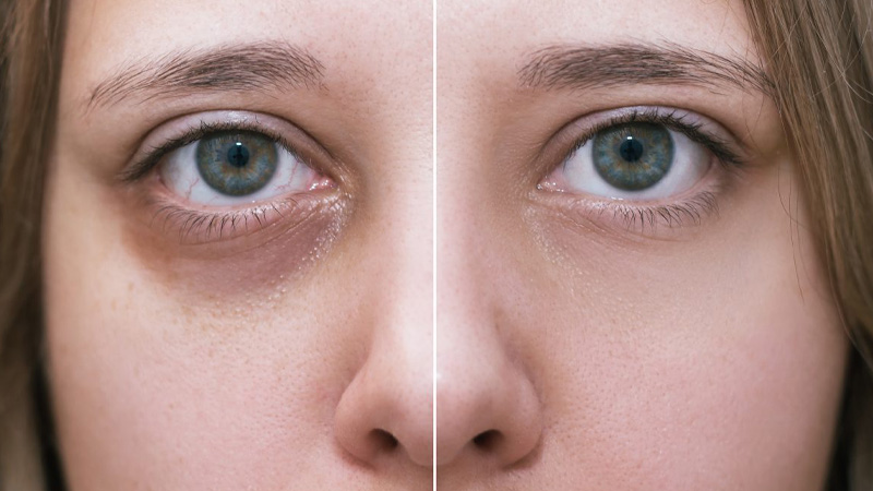 کبودی بعد از تزریق فیلر زیر چشم | دلایل، پیشگیری و درمان