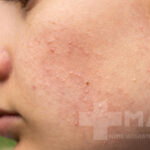 درمان جوش های ریز زیر پوستی صورت