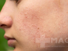 درمان جوش های ریز زیر پوستی صورت