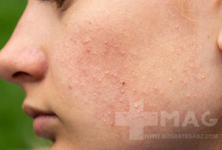 درمان جوش های ریز زیر پوستی صورت 7 درمان جوش های ریز زیر پوستی صورت