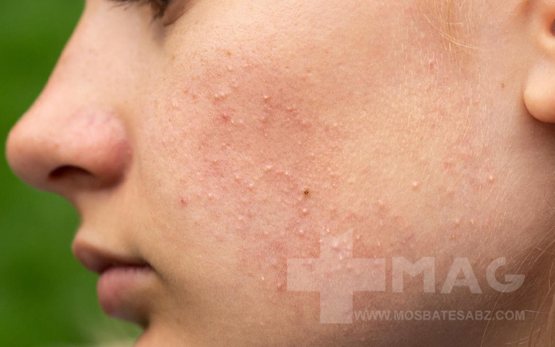 درمان جوش های ریز زیر پوستی صورت 1 درمان جوش های ریز زیر پوستی صورت
