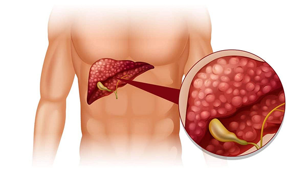 بیماریهای خاموش کبد و الزام به بررسی و پیگیری 1 بیماریهای خاموش کبد و الزام به بررسی و پیگیری
